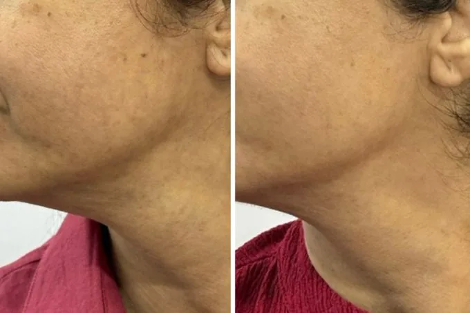 Skin Texture Result